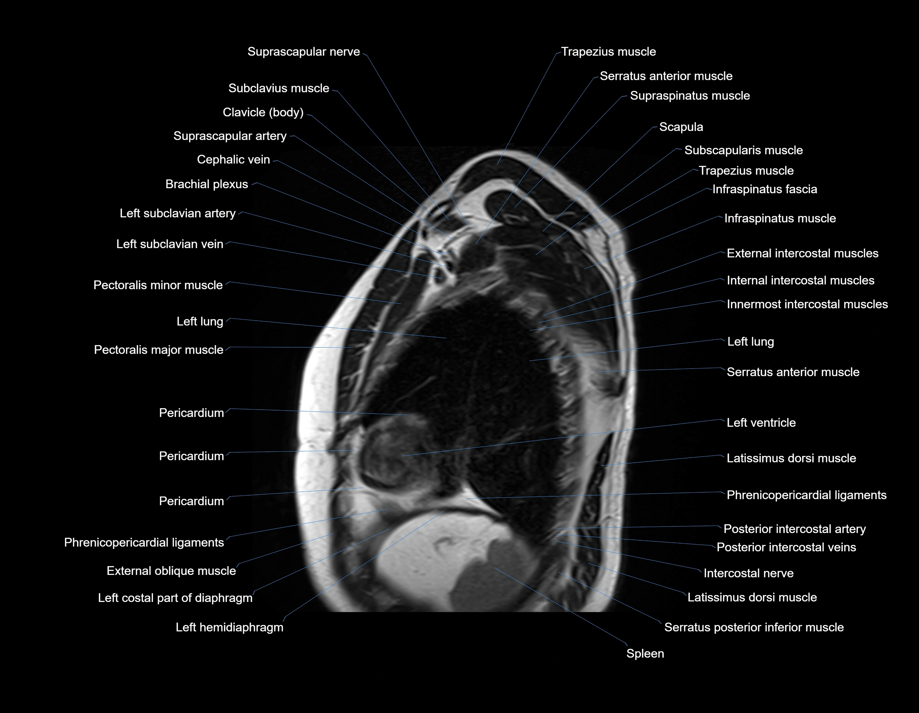 MRI chest (thorax) sagittal labelled cross sectional anatomy 3T radiology image-img-00001-00031.webp